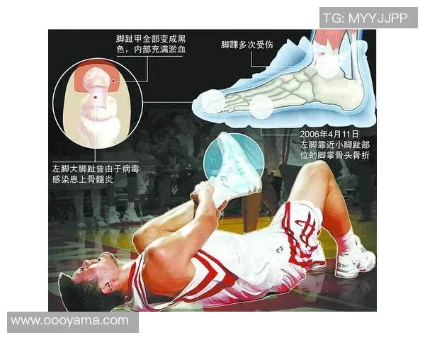 姚明因疲劳骨折重创赛季前景球迷期待他早日复出重返赛场